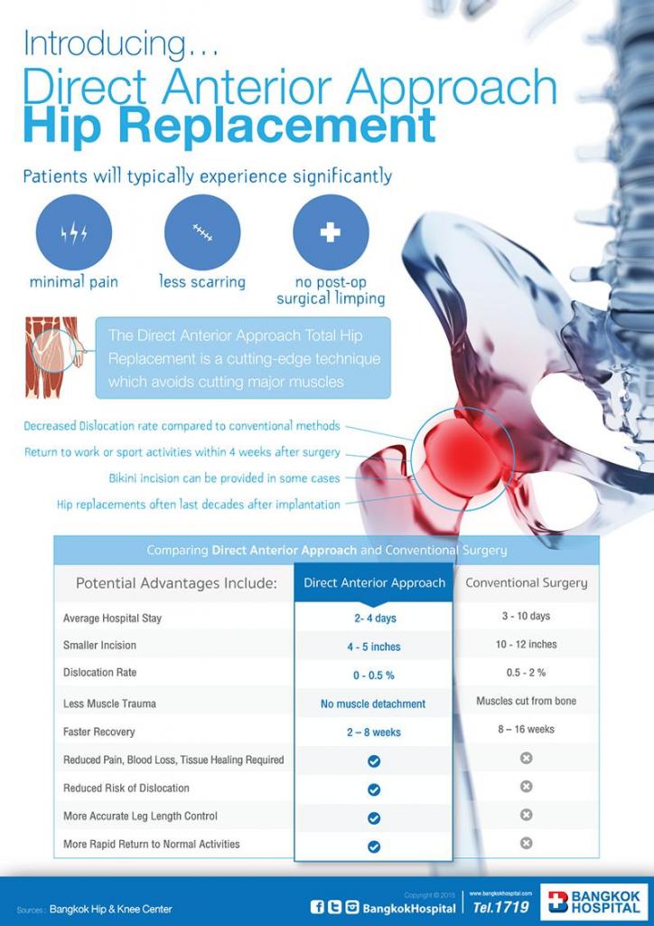 Introducing Direct Anterior Approach Hip Replacement Bangkok International Hospital