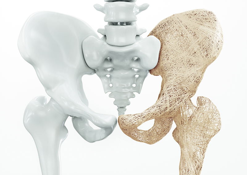 Osteoporosis a silent danger | Bangkok International Hospital