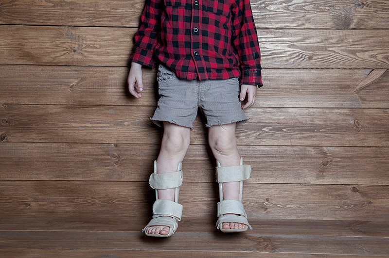 6 ปัญหาเท้าผิดรูปในเด็กเล็ก